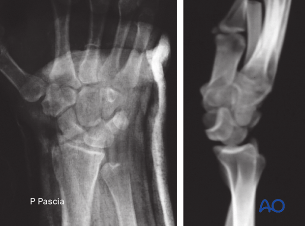 Lateral x-ray of the carpus with a lunate dislocation