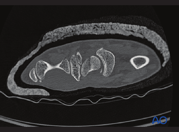 CT scan showing a scaphoid waist fracture.