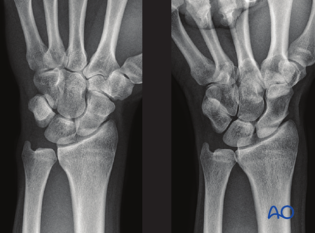 Stress x-ray imaging - the x-ray with a clenched fist (right image) shows a gap at the scapholunate junction indicating a scapholunate ligament injury with dissociation.