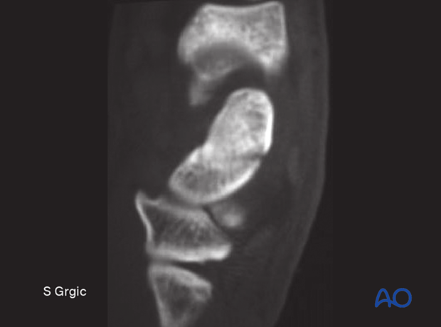 2-D CT scan showing a fracture with minimal displacement through both cortices of the scaphoid in the sagittal plane.