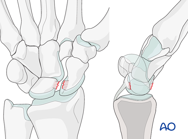 Perilunate injury classification Stage I: scapholunate ligament injury