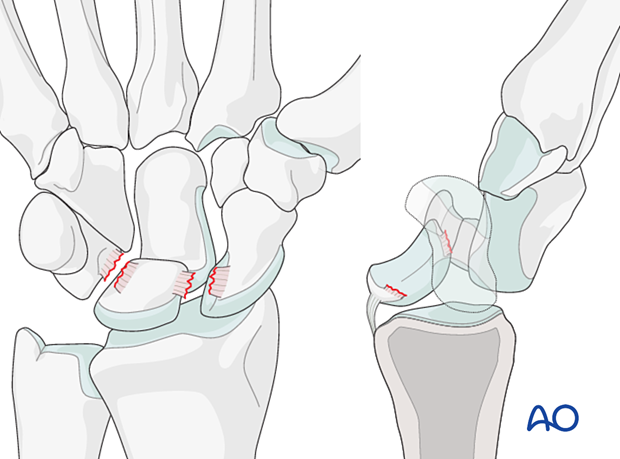 Perilunate injury classification Stage III: midcarpal dislocation