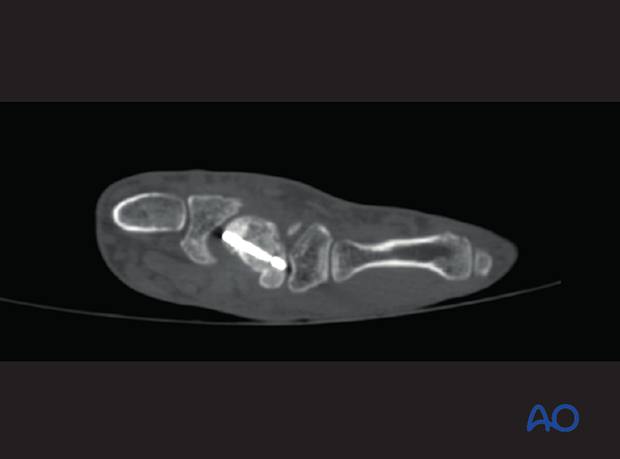 CT of a scaphoid malunion managed with bone graft and headless compression screw