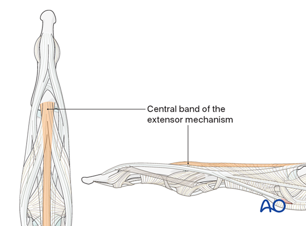 Central band of the extensor mechanism of the middle phalangeal base – finger.