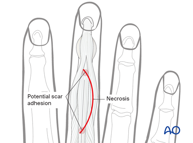 Curved skin incision of the 3rd proximal interphalangeal joint showing possible scar adhesion and necrotic sites 