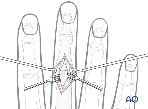 Dorsal approach to the PIP joint