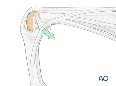 Dorsal approaches to the proximal interphalangeal joint