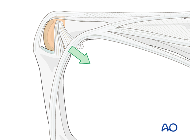 Improving proximal interphalangeal joint exposure with flexion