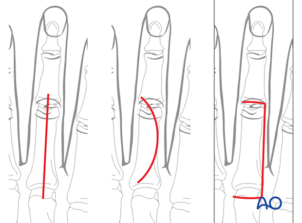 Dorsal approach to the proximal phalanx (after Pratt)