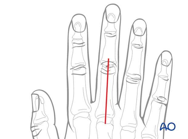 Straight dorsal incision of the 3rd proximal interphalangeal joint