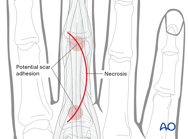 Curved skin incision of the 3rd proximal interphalangeal joint showing scar adhesion and necrotic sites