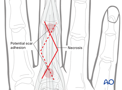 Dorsal Approach To The Proximal Phalanx (after Pratt)