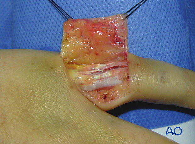 Skin elevation of the dorsal fasciocutaneous flap - finger