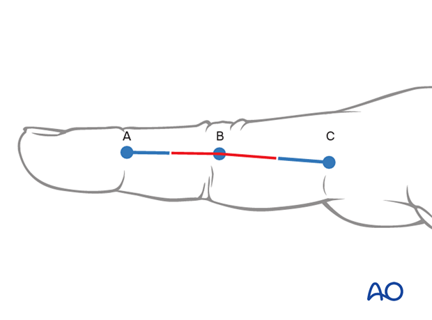 Midaxial approach to the PIP joint