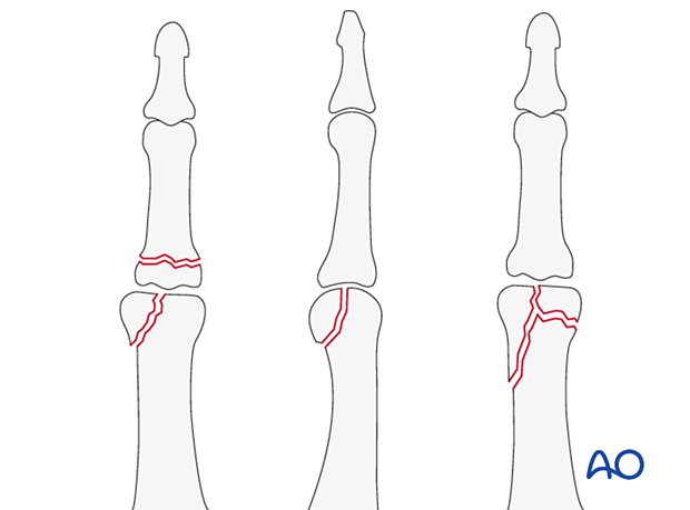 Intraarticular phalangeal fractures - hand