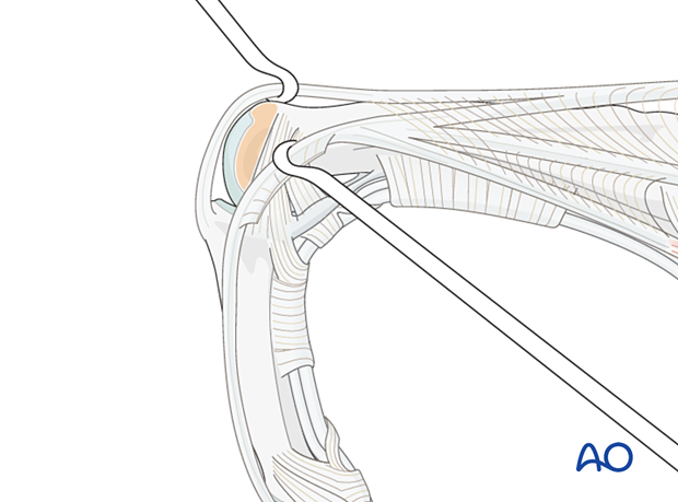 Flexion of the proximal joint to develop an additional window. 