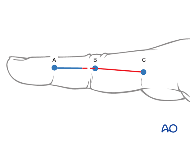 Midaxial approach to the proximal phalanx