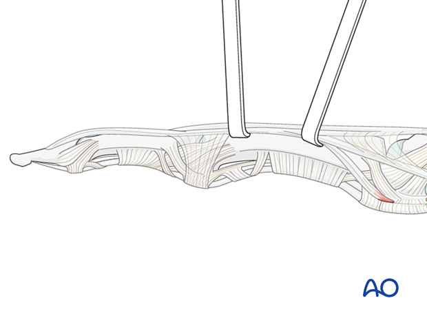 Retraction of the oblique fibers of the lateral band