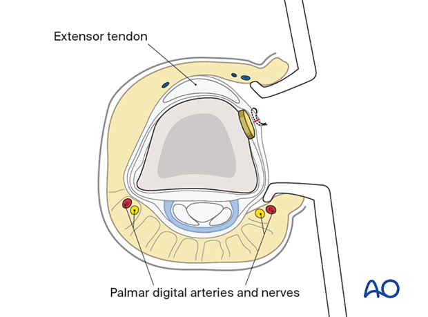 Tendon sheath repair with nonabsorbable monofilament sutures – proximal phalanx