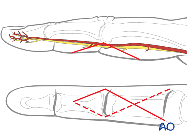 Palmar approach skin incision to proximal interphalangeal joint