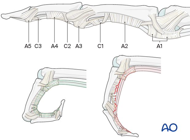 A2 and A4 flexor tendon pulley preservation and bowstringing during flexion.