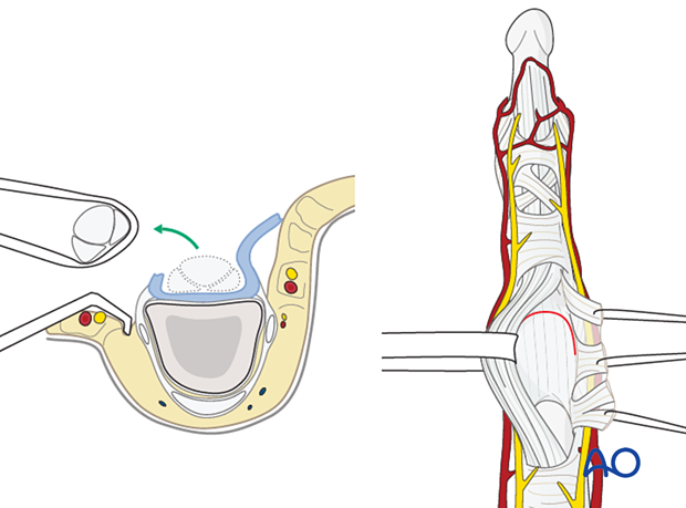 Volar plate detached as flap and retracted flexor tendons for full joint exposure 