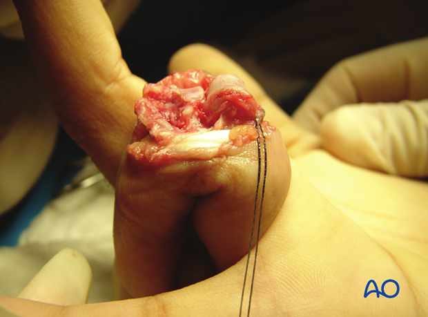 Clinical image of fully opened proximal interphalangeal joint exposes base of middle phalanx