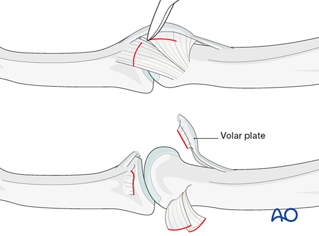 Incision then bilaterally detached and dorsally retracted collateral ligaments