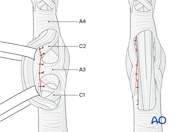 Repaired A3, C1, and C2 flexor tendon pulleys repaired