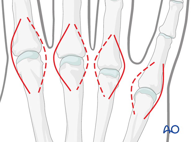 Dorsal approach skin incisions to the metacarpophalangeal joint