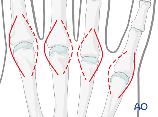 Dorsal approach to the metacarpophalangeal joints