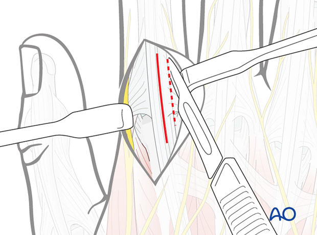 Extensor digitorum tendon longitudinal incision and dorsoulnar extensor hood incision