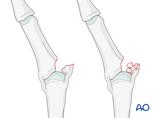 Simple and multifragmentary avulsion fractures of the phalangeal proximal end segment