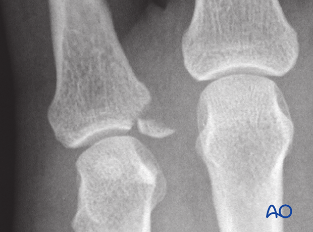 AP view x-ray of an avulsion fracture of proximal end segment