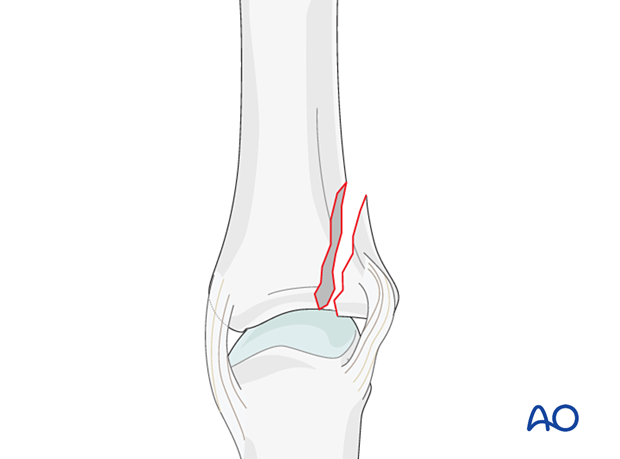 Partial articular shearing fracture of the phalangeal proximal end segment