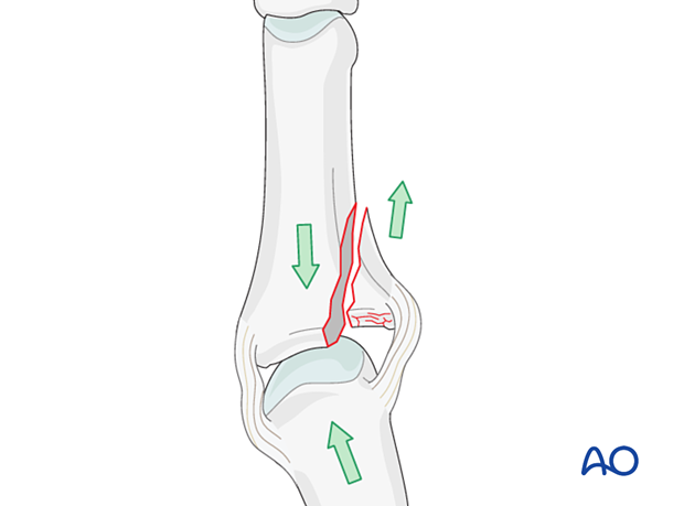 The combination of compression and shearing forces resulting in a shear fracture