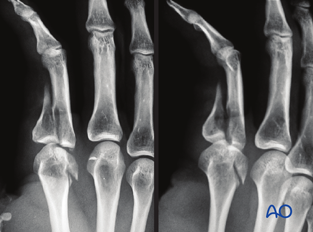 AP and oblique x-ray of a partial articular fracture of the 2nd proximal phalangeal base and the metacarpal head