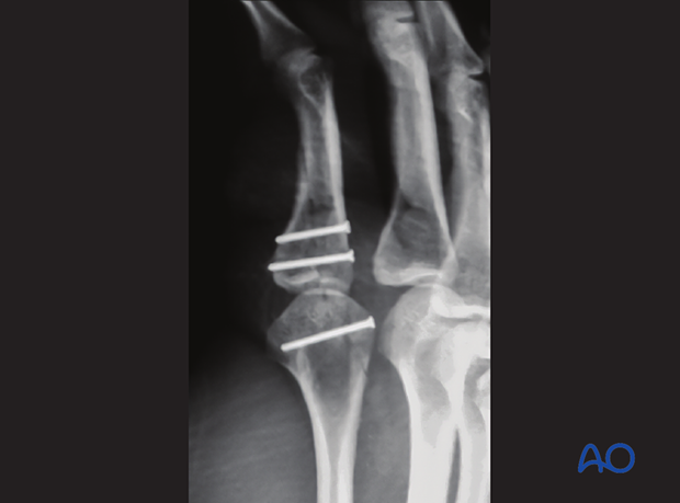 Oblique x-ray of fixation of a partial articular fracture of the 2nd proximal phalangeal base and the metacarpal head