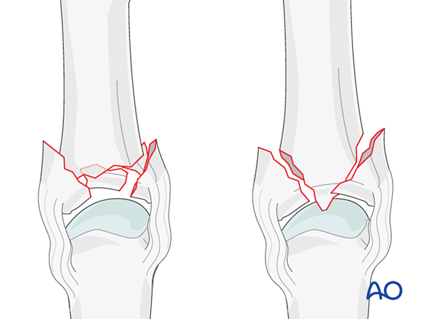 Complete articular fractures in two configurations, centrally impacted multifragmentary and Y-type