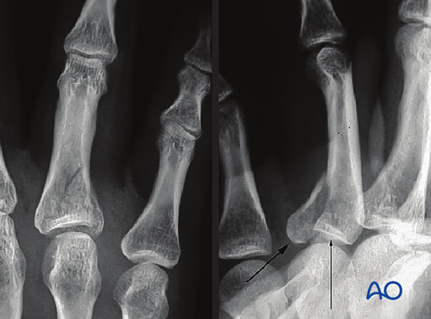 X-rays of an articular fracture of a proximal phalangeal base