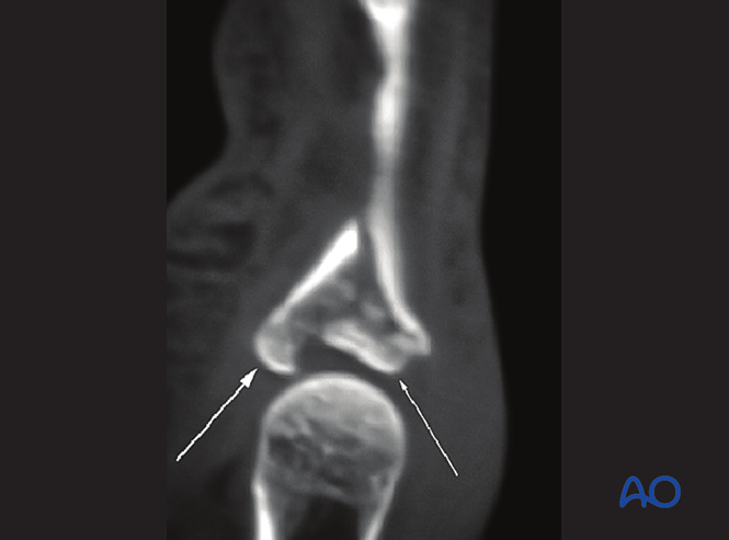 Complete articular fracture of the proximal end segment