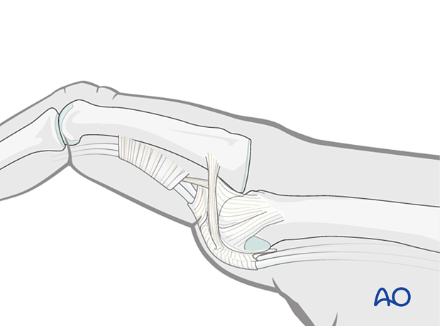 Dorsal dislocation of the MCP joint