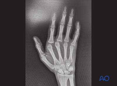 Dislocation of the metacarpophalangeal joint