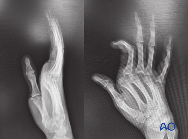 The extent of dislocation is better visible in the lateral and oblique x-rays.