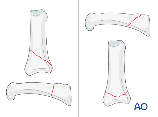 Oblique extraarticular fractures of the proximal phalangeal base