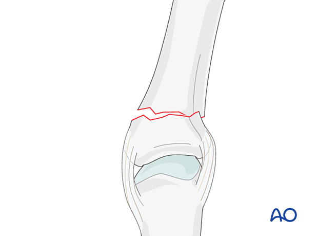 Transverse extraarticular fracture of the proximal end segment