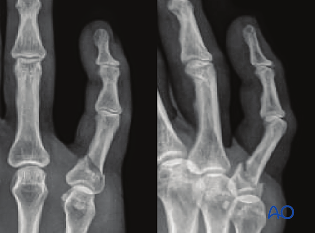 AP and oblique x-rays show a transverse base fracture of the 5th proximal phalanx