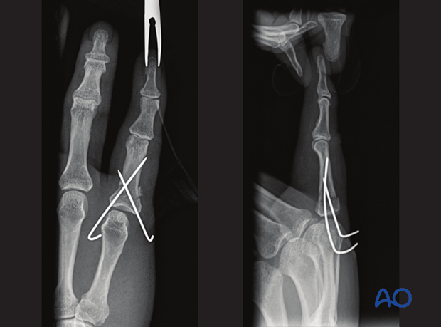 X-rays show fixation with two K-wires of a transverse base fracture of the 5th proximal phalanx