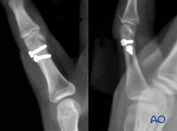 X-rays show fixation with two lag screws of an oblique fractures of the diaphyseal phalanx - Proximal phalanx hand