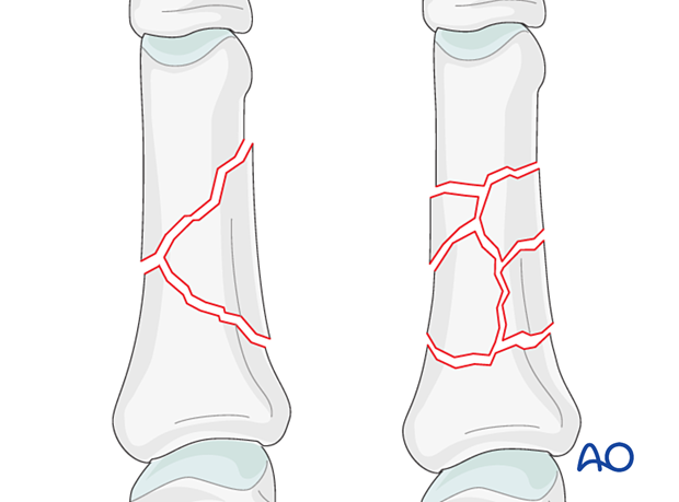 AP view of a wedge and a multifragmentary fracture of the diaphyseal phalanx - Proximal phalanx hand